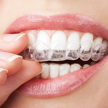 Patient placing Invisalign clear aligner tray